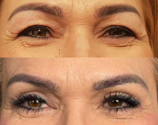 korekta powiek - porównanie przed i po